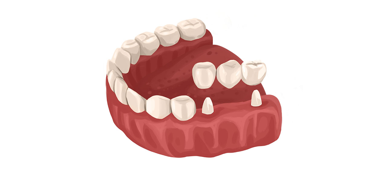 Dental Bridges